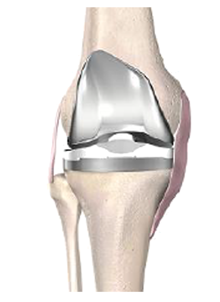 Robotic total knee replacement