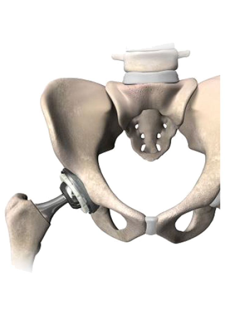 Robotic total Hip replacement